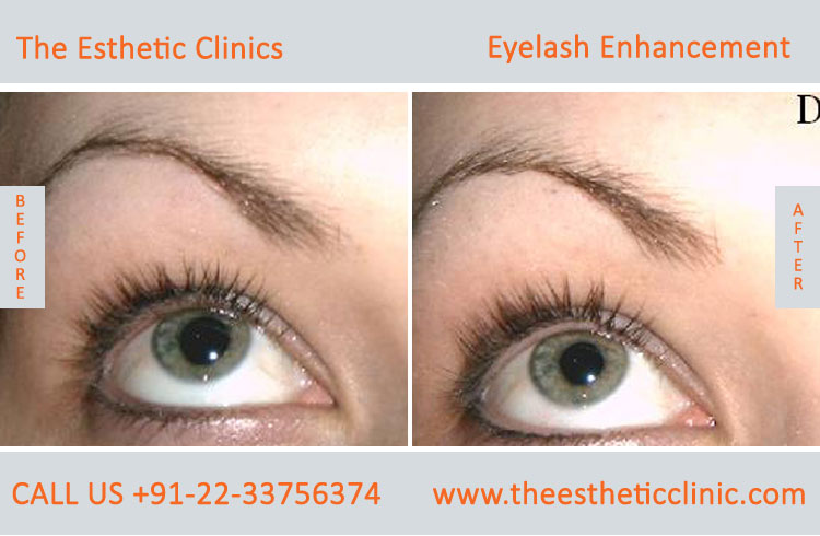 Eyelash Enhancement Surgery, Latisse Eyelash Treatment before after photos in mumbai india (2)